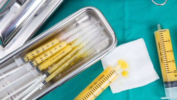 l'augmentation mammaire par lippostructure (lipofilling mammaire)