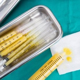l'augmentation mammaire par lippostructure (lipofilling mammaire)