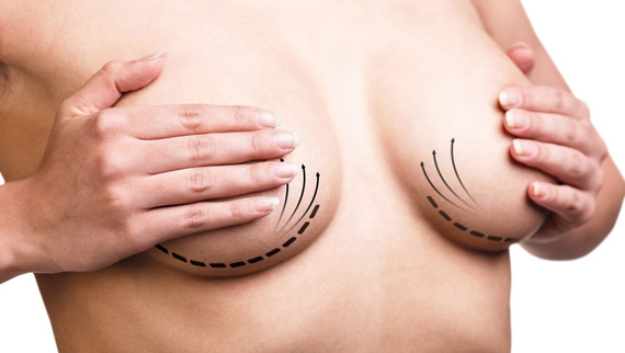 Augmentation mammaire par prothèses (implants) à Nîmes