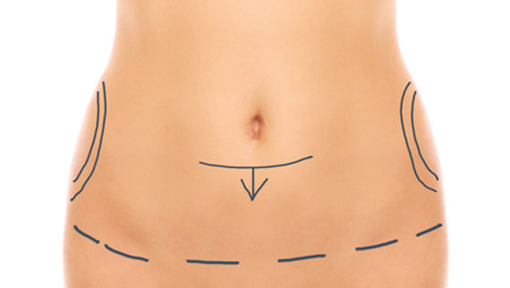 chirurgie de la silhouette