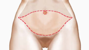 Abdominoplastie
