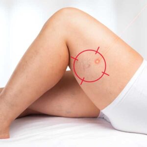Laser vasculaire à Nîmes
