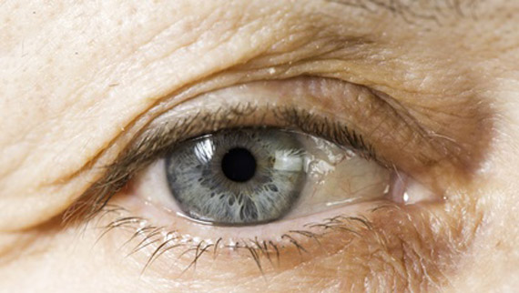Botox ou toxine botulique estompe vos rides d’expression