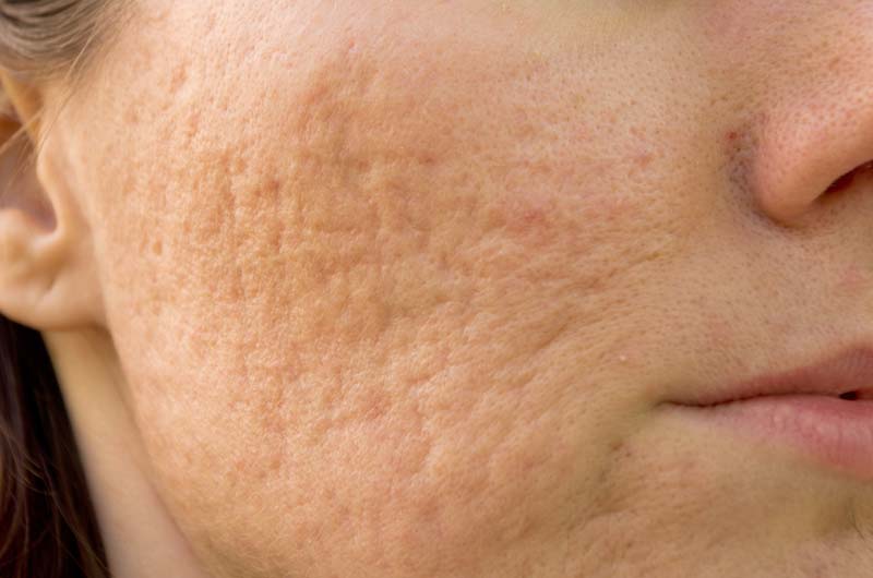 Enlever ses cicatrices d’acné grâce au laser Erbium-YAG